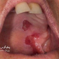 بیماری پمفیگوس (Pemphigus) و راههای درمان آن
