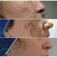 درمان اسکار آکنه بوسیله پانچ انجام شده توسط آقای دکتر محمد گلشنی