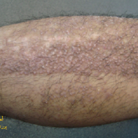 آمیلوئیدوز پوستی 