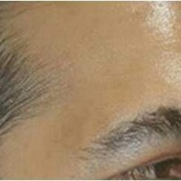 درمان و زیبایی با لیفت ابرو (brow's lift)