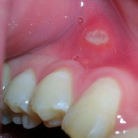 آفت دهان (mouth aphthous) و راههای درمان آن