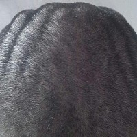 دلیل به وجود آمدن بیماری Cutis verticis gyrata چیست؟