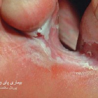 عکس بیماری پای ورزشکار