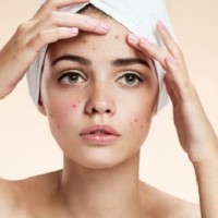 آیا آرایش کردن، می تواند سبب بروز آکنه شود؟