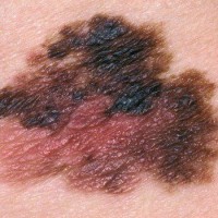 آشنایی با تومور بدخیم ملانوم (Melanoma)