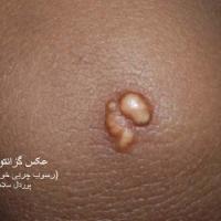 عکس گزانتوم توبروس