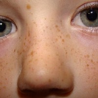 برای درمان کک و مک صورت، ایجاد شادابی در پوست و کاهش خشکی پوست چه روشی پیشنهاد می کنید؟