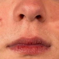 آيا راهی برای از بين بردن لکه های سیاه بعد از جوش و زخم وجود دارد؟