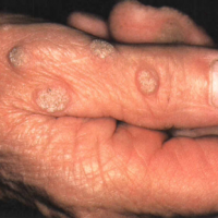 زگیل (Wart) و راههای درمان آن