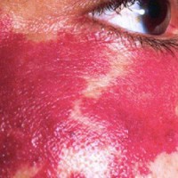 خال لکه شرابی Port Wine Stain 