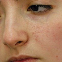 بایدها و نباید های جوش های صورت