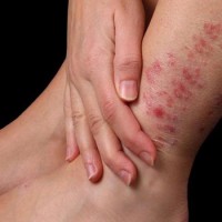 دخترم دچار ضایعات پوستی روی دست و پا و صورت شده، آیا  این بیماری درمان دارد؟