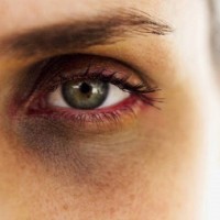 آیا هاله سیاه دورچشم بیماری پوستی است؟