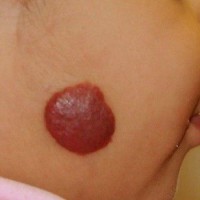 همانژیوم شیرخواری شایع ترین تومور بافت نرم در شیرخواران 