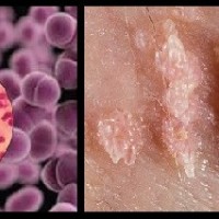 هشدار درمورد افزایش شیوع سوزاک، تبخال و زگیل تناسلی