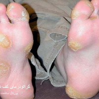 عکس کراتودرمای کف دست و پا