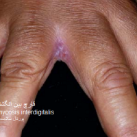 عکس عفونت قارچی بین انگشتان دست