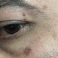 در صورتم یک لک قهوه ای بزرگ ایجاد شده است. روش از بین بردن آن چیست؟