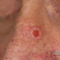 از تومورهای بدخیم پوست (skin cancer) بیشتر بدانیم