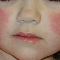 آشنایی با بیماری درماتیت آتوپیک و راههای درمان آن (بخش دوم)