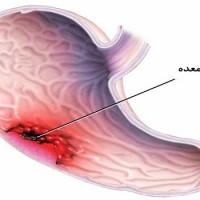 کشف روش جدید غربالگری بیماری سرطان معده
