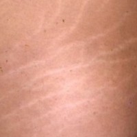 چگونه ميتوان از بروز تركهاي حاملگي جلوگيري كرد و چه راه‌هایی برای پیشگیری وجود دارد؟