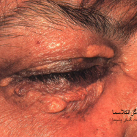 عکس رسوب چربی در پلک 