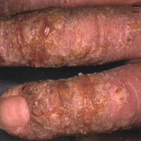 اگزمای شدید دست