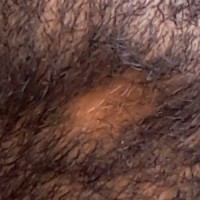 درمان ریزش موی صورت به صورت سکه ای چیست؟