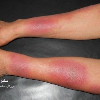 عکس سندروم سوییت