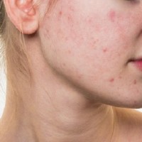 آیا مصرف شکلات و آجیل باعث جوش می شود؟