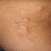 آیا اسکارهای خطی می توانند قابل درمان باشند؟