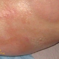 عکس مورفه آ