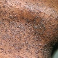 عکس سودو فولیکولیت