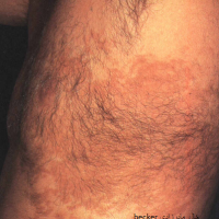 خال  مادرزادی becker