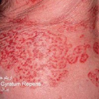 عکس بیماری اریتم جیراتوم ریپنس