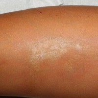 بیماری مورفه آ (Morphea) چیست؟