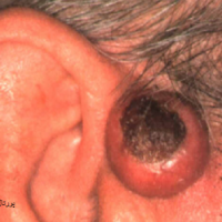 عکس کراتوآکانتوم