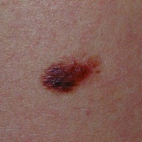 خال دیسپلاستیک (Dysplastic Nevus)