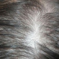 آیا کاشت مو برای من مناسب است و راه حل پرپشت شدن موهای من چه می باشد؟