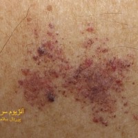 عکس آنژیوم سرپیجینوزوم