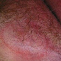 کچلی کشاله ران (Tinea Cruris)