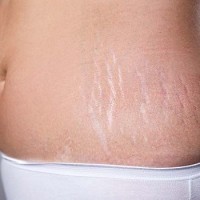 روش های مناسب جهت درمان استریاهای ناشی از حاملگی