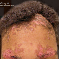 لوپوس جلدی (DLE)