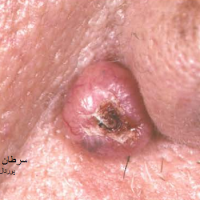 عکس سرطان سلولهای بازال(قاعده ای)