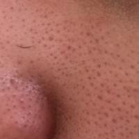 منافذ باز پوست صورتم با لایه بردار درمان میشود یا نه؟