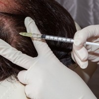 PRP در درمان ریزش مو، بهتر است به تنهایی استفاده شود یا همراه با سایر داروهای تقویت کننده مو؟
