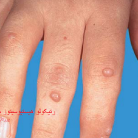 عکس رتیکولو هیستیوسیتوز مولتی سنتریک