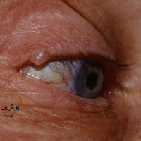 عکس هیدروسیستوم آپوکرین