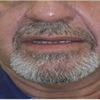لیفت قسمت میانی صورت (mid face thread lift)